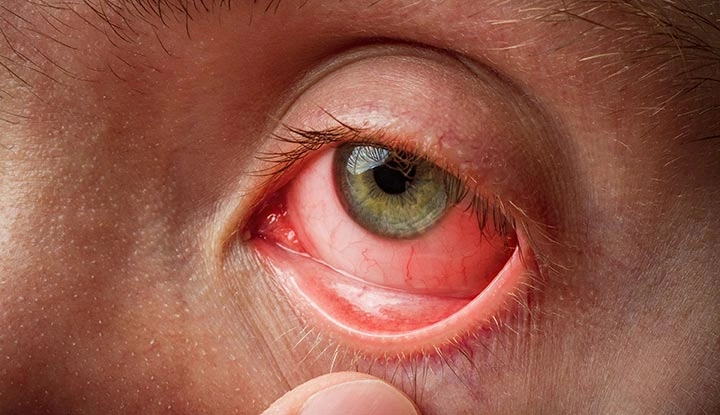 Conjunctivitis - Natural Treatment at Deepak Nature Cure