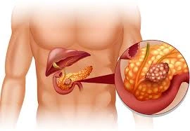 Pancreatitis - Natural Treatment at Deepak Nature Cure