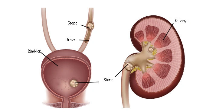 Renal Colic - Natural Treatment at Deepak Nature Cure