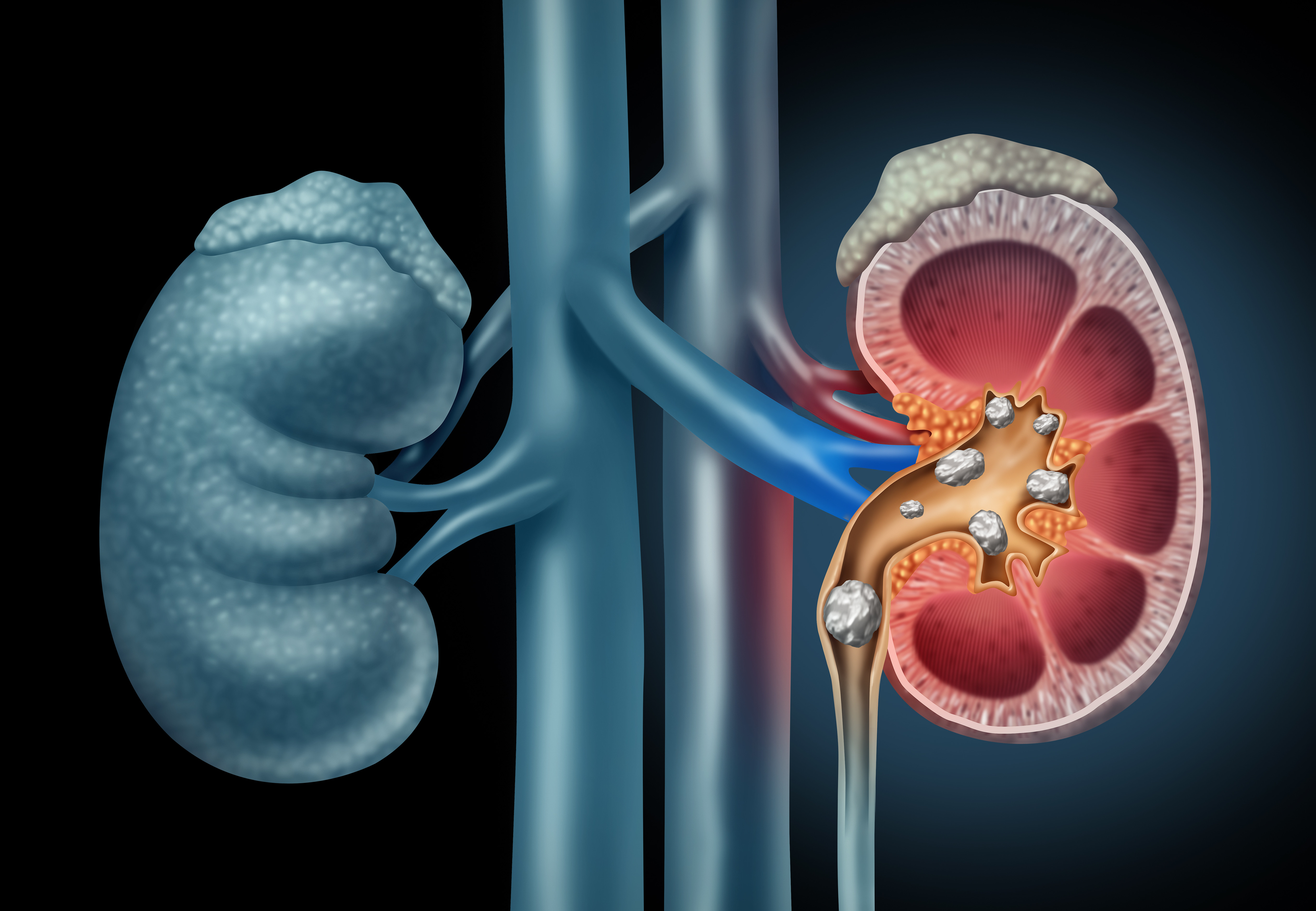 Kidney Stones - Natural Treatment at Deepak Nature Cure
