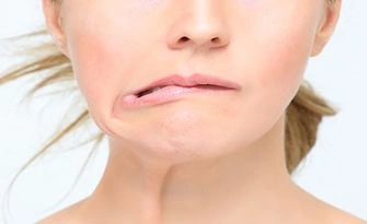 Bell's palsy - Natural Treatment at Deepak Nature Cure