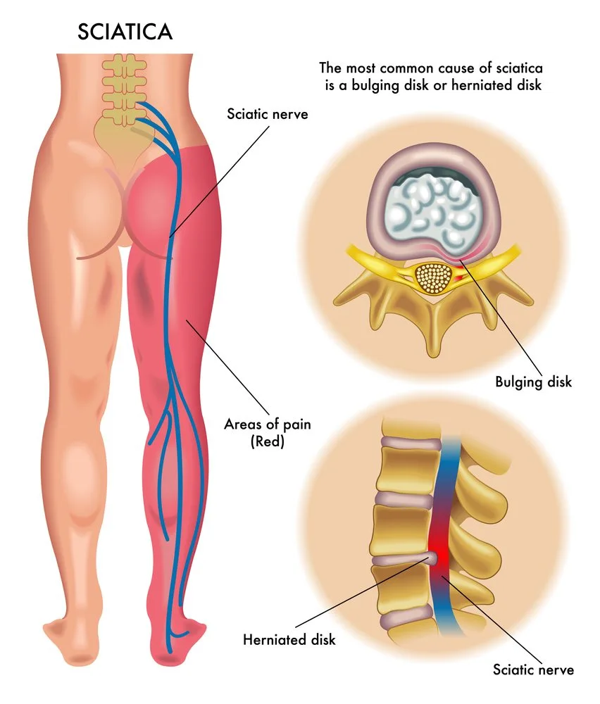 Sciatica - Natural Treatment at Deepak Nature Cure