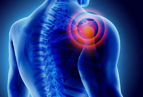 Frozen Shoulder - Natural Treatment at Deepak Nature Cure