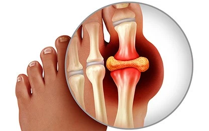 Gouth - Natural Treatment at Deepak Nature Cure