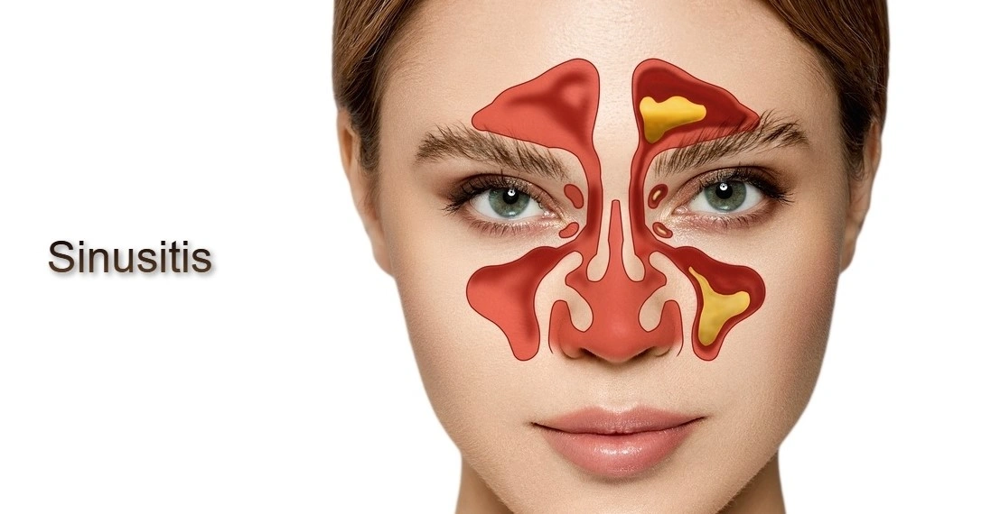 Sinusitis - Natural Treatment at Deepak Nature Cure