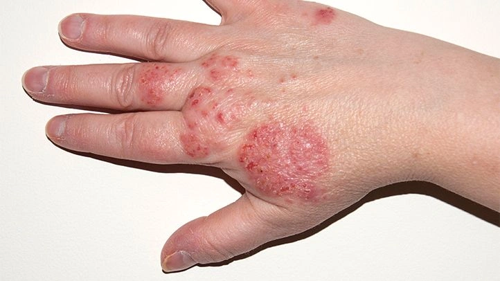 Eczema - Natural Treatment at Deepak Nature Cure
